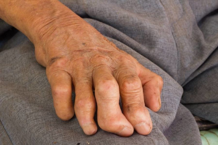 Left-hand leprosy